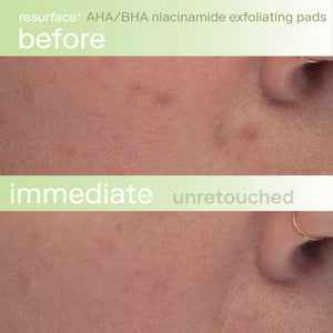 Resurface+ AHA/BHA Niacinamide Exfoliating Pads for Face and Targeted Body