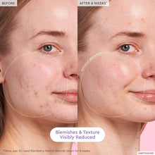 Load image into Gallery viewer, Blackberry Retinol Blemish Serum